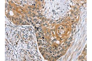The image on the left is immunohistochemistry of paraffin-embedded Human esophagus cancer tissue using ABIN7192155(RBM38 Antibody) at dilution 1/35, on the right is treated with synthetic peptide. (RBM38 Antikörper)