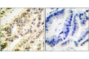Immunohistochemistry analysis of paraffin-embedded human breast carcinoma, using SGK (Phospho-Ser422) Antibody. (SGK1 Antikörper  (pSer422))
