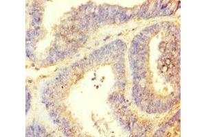 Immunohistochemistry of paraffin-embedded human endometrial cancer using ABIN7164621 at dilution of 1:100 (TTLL9 Antikörper  (AA 1-230))