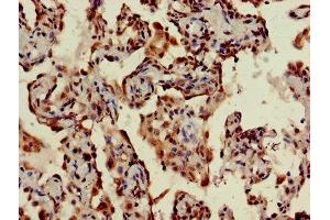 IHC image of ABIN7170794 diluted at 1:400 and staining in paraffin-embedded human lung cancer performed on a Leica BondTM system. (STING/TMEM173 Antikörper  (AA 207-379))