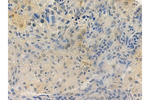 ABIN6265916 and ABIN6277797 at 1/100 staining human lung squamous cell carcinoma by IHC-P.
