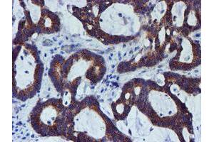 Immunohistochemical staining of paraffin-embedded Adenocarcinoma of Human colon tissue using anti-PDSS2 mouse monoclonal antibody. (PDSS2 Antikörper)