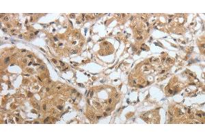 Immunohistochemistry of paraffin-embedded Human lung cancer using Amphiphysin I Polyclonal Antibody at dilution of 1:30 (Amphiphysin Antikörper)