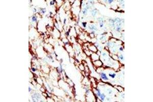 Formalin-fixed and paraffin-embedded human cancer tissue reacted with the primary antibody, which was peroxidase-conjugated to the secondary antibody, followed by AEC staining. (EPH Receptor A7 Antikörper  (C-Term))