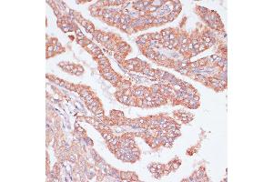 Immunohistochemistry of paraffin-embedded Human thyroid cancer using CDC20 antibody (ABIN7266246) at dilution of 1:100 (40x lens). (CDC20 Antikörper  (AA 1-270))