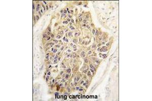 Formalin-fixed and paraffin-embedded human lung carcinoma tissue reacted with MAGEA1 Antibody , which was peroxidase-conjugated to the secondary antibody, followed by DAB staining. (MAGEA1 Antikörper  (AA 143-173))