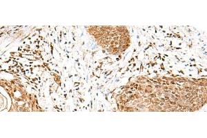 Immunohistochemistry of paraffin-embedded Human esophagus cancer tissue using GMPPB Polyclonal Antibody at dilution of 1:50(x200) (GMPPB Antikörper)