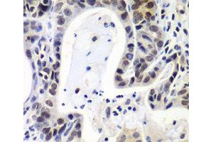 Immunohistochemistry of paraffin-embedded Human gastric cancer using LSM2 Polyclonal Antibody at dilution of 1:100 (40x lens). (LSM2 Antikörper)