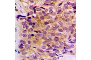 Immunohistochemical analysis of Cytokeratin 10 staining in human breast cancer formalin fixed paraffin embedded tissue section. (Keratin 10 Antikörper  (Center))
