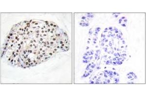 Immunohistochemistry analysis of paraffin-embedded human breast carcinoma tissue, using HDAC1 (Ab-421) Antibody.