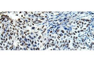 Immunohistochemistry of paraffin-embedded Human esophagus cancer tissue using DDX39A Polyclonal Antibody at dilution of 1:65(x200) (DDX39 Antikörper)