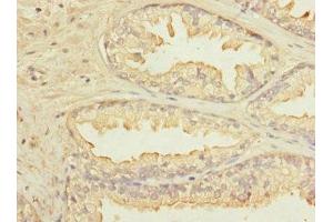 Immunohistochemistry of paraffin-embedded human prostate cancer using ABIN7157271 at dilution of 1:100