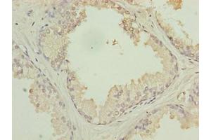 Immunohistochemistry of paraffin-embedded human prostate cancer using ABIN7175441 at dilution of 1:100 (PTPLB Antikörper  (AA 7-41))