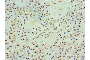 Immunohistochemistry of paraffin-embedded human breast cancer using ABIN7146438 at dilution of 1:100 (CAMK1G Antikörper  (AA 217-476))