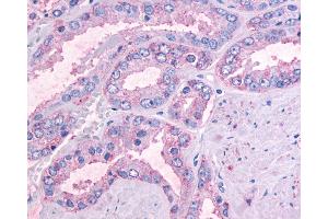 Anti-OR51E1 antibody IHC of human Prostate, Carcinoma. (OR51E1 Antikörper  (Cytoplasmic Domain))