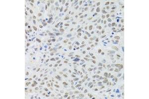 Immunohistochemistry of paraffin-embedded human lung cancer using DDB1 Antibody. (DDB1 Antikörper)