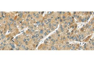 Immunohistochemistry of paraffin-embedded Human liver cancer using TMPRSS11D Polyclonal Antibody at dilution of 1/35 (TMPRSS11D Antikörper)