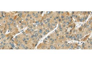 Immunohistochemistry of paraffin-embedded Human liver cancer using TMPRSS11D Polyclonal Antibody at dilution of 1/35 (TMPRSS11D Antikörper)