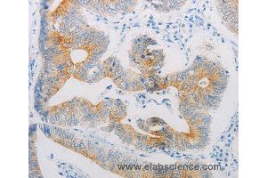 Immunohistochemistry of Human colon cancer using ADRB2 Polyclonal Antibody at dilution of 1:20