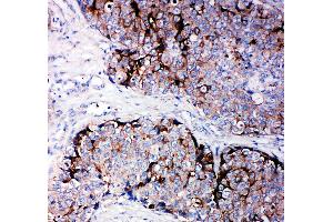 Anti-TIMP2 antibody, IHC(P) IHC(P): Human Mammary Cancer Tissue (TIMP2 Antikörper  (C-Term))