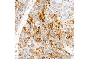 Immunohistochemistry of paraffin-embedded Human esophageal cancer using  antibody (ABIN7265531) at dilution of 400(40x lens). (ALDH1A1 Antikörper)