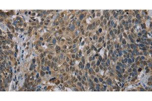 Immunohistochemistry of paraffin-embedded Human cervical cancer using UBP1 Polyclonal Antibody at dilution of 1:40 (UBP1 Antikörper)