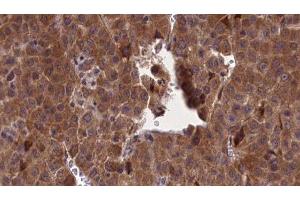 ABIN6277173 at 1/100 staining Human liver cancer tissue by IHC-P. (Selectin E/CD62e Antikörper  (N-Term))