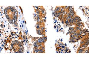 Immunohistochemistry of paraffin-embedded Human colon cancer using NCK1 Polyclonal Antibody at dilution of 1:30 (NCK1 Antikörper)