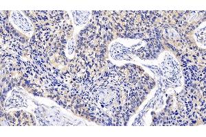 Detection of MAPK14 in Human Bladder Cancer Tissue using Polyclonal Antibody to Mitogen Activated Protein Kinase 14 (MAPK14) (MAPK14 Antikörper  (AA 19-279))