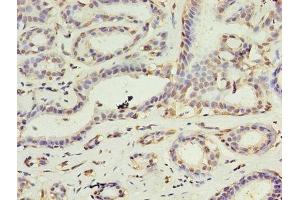 Immunohistochemistry of paraffin-embedded human breast cancer using ABIN7149554 at dilution of 1:100