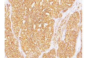 Formalin-fixed, paraffin-embedded human Renal Cell Carcinoma stained with RCC Monoclonal Antibody (SPM487). (CA9 Antikörper)