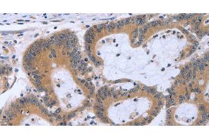 Immunohistochemistry of paraffin-embedded Human colon cancer using MAPRE3 Polyclonal Antibody at dilution of 1:30 (ECE1 Antikörper)