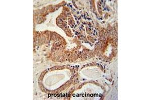 IGF2BP1 antibody (C-term) immunohistochemistry analysis in formalin fixed and paraffin embedded human prostate carcinoma followed by peroxidase conjugation of the secondary antibody and DAB staining.