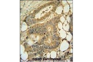 EPS8L3 Antibody (N-term) (ABIN390898 and ABIN2841105) immunohistochemistry analysis in formalin fixed and paraffin embedded human colon carcinoma followed by peroxidase conjugation of the secondary antibody and DAB staining. (EPS8-Like 3 Antikörper  (N-Term))