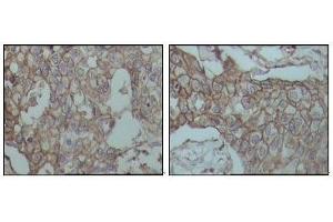Immunohistochemical analysis of paraffin-embedded human breast carcinoma tissues, showing membrane localization with DAB staining using CD44 mouse mAb.