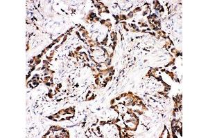 IHC-P: APLP1 antibody testing of human lung cancer tissue (APLP1 Antikörper  (N-Term))