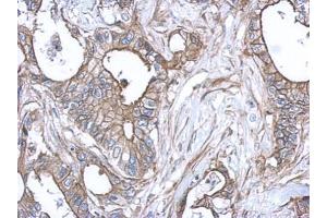 IHC-P Image Immunohistochemical analysis of paraffin-embedded human gastric cancer, using S100A10, antibody at 1:500 dilution. (S100A10 Antikörper)
