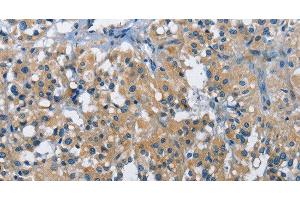 Immunohistochemistry of paraffin-embedded Human thyroid cancer tissue using BMPR1B Polyclonal Antibody at dilution 1:30 (BMPR1B Antikörper)