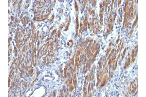 Formalin-fixed, paraffin-embedded human Leiomyosarcoma stained with SM-MHC Monoclonal Antibody (SMMS-1). (MYH11 Antikörper)