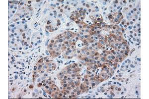 Immunohistochemical staining of paraffin-embedded Carcinoma of kidney tissue using anti-SERPINA1mouse monoclonal antibody. (SERPINA1 Antikörper)