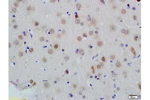 Formalin-fixed and paraffin embedded human colon carcinoma labeled with Anti-ID1 Polyclonal Antibody, Unconjugated (ABIN700330) at 1:200 followed by conjugation to the secondary antibody and DAB staining