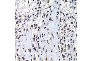 Immunohistochemistry of paraffin-embedded human kidney cancer using H2AFY antibody at dilution of 1:100 (x400 lens). (H2AFY Antikörper)