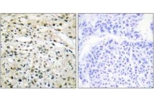 Immunohistochemistry analysis of paraffin-embedded human liver carcinoma tissue, using DNMT3B Antibody.
