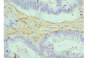 Immunohistochemistry of paraffin-embedded human colon cancer using ABIN7146462 at dilution of 1:100 (Caldesmon Antikörper  (AA 1-240))