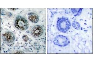 Immunohistochemistry analysis of paraffin-embedded human breast carcinoma tissue, using GAP43 (Ab-41) Antibody. (GAP43 Antikörper  (AA 8-57))