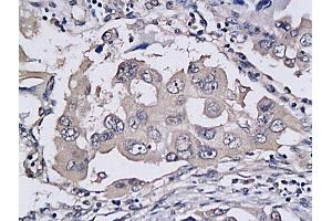 Formalin-fixed and paraffin embedded human colon cancer labeled with Anti-TRAILR2/DR5/CD262 Polyclonal Antibody, Unconjugated (ABIN733118) followed by conjugation to the secondary antibody and DAB staining