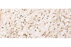 Immunohistochemistry of paraffin-embedded Human ovarian cancer tissue using RRP1 Polyclonal Antibody at dilution of 1:45(x200)