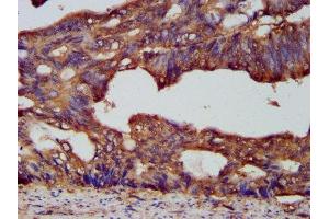 IHC image of ABIN7164828 diluted at 1:200 and staining in paraffin-embedded human colon cancer performed on a Leica BondTM system. (PCSK7 Antikörper  (AA 189-362))