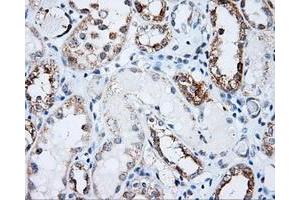 Immunohistochemical staining of paraffin-embedded Carcinoma of prostate tissue using anti-LIPG mouse monoclonal antibody. (LIPG Antikörper)