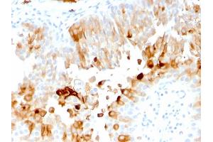 Formalin-fixed, paraffin-embedded human Urothelial Carcinoma stained with Uroplakin 1A Mouse Monoclonal Antibody (UPK1A/2921).